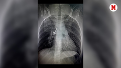 La operación donde sacaron una llave del pulmón de una niña
