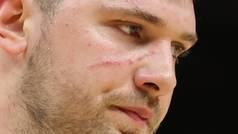 Doncic jugó maltrecho contra los Warriors: arañazo en la cara y dolores en el hombro