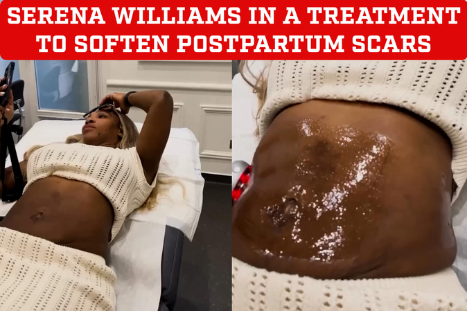 Serena Williams reveals her body with innovative treatment to smooth postpartum scars